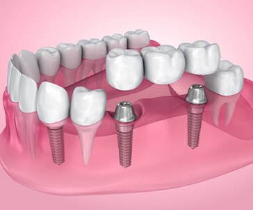 Illustration of dental implants with crown and bridge