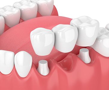 Illustration of traditional dental bridge