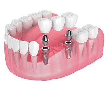 Illustration of implant bridge