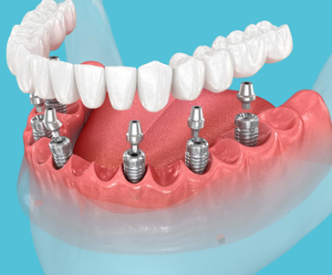 Rendering of lower arch of implant dentures with light blue background