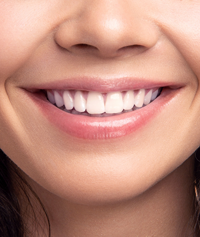 Close-up of smile after dental treatment in Jacksonville Beach