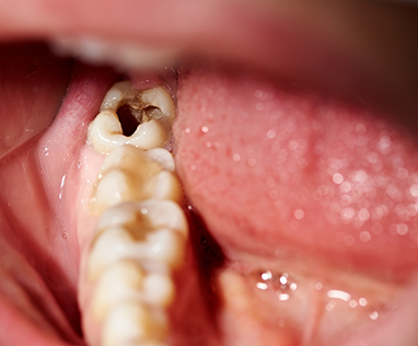 Badly decayed teeth in the lower arch
