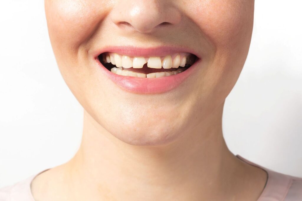 Nose-to-neck view of someone with chipped front tooth smiling