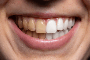 A patient’s smile with stained teeth on the left and white teeth on the right