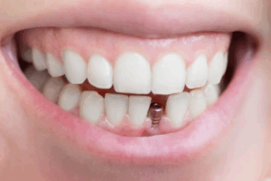 Close up of a smile with a dental implant